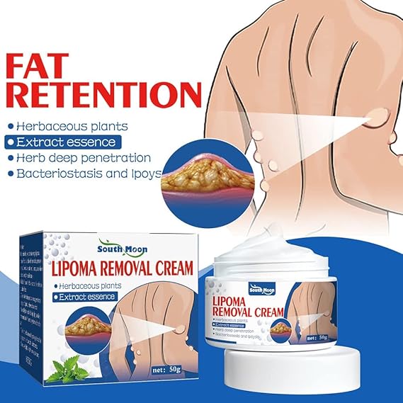 South Moon Lipoma Removal Cream || SUMMER SALE OFFER.